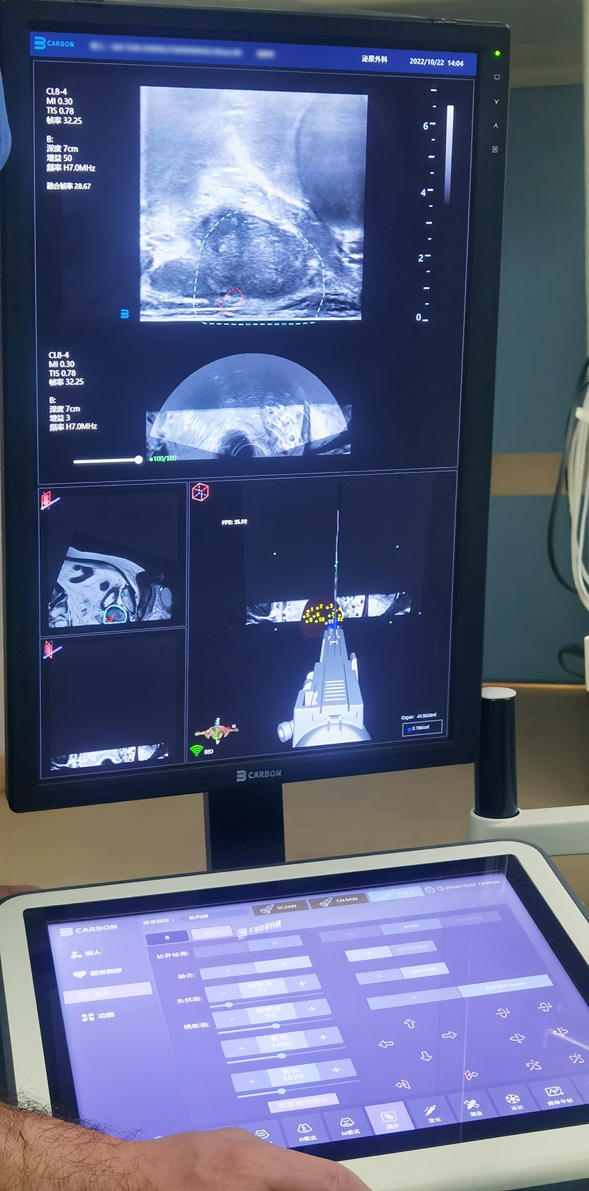 卡本医疗VENUS助湘雅医院祖雄兵教授团队MRI—TRUS微创手术再创新高