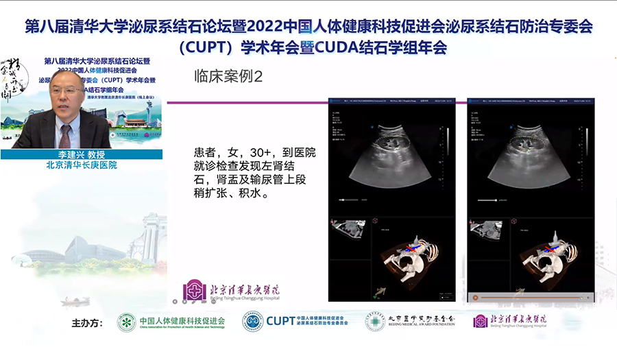 卡本医疗携手清华长庚医院推进PCNL精准诊疗新发展，将促进泌尿外科疾病治疗向精准化、微创化方向迈进，加快泌尿外科病患者术后恢复，节约医疗成本。