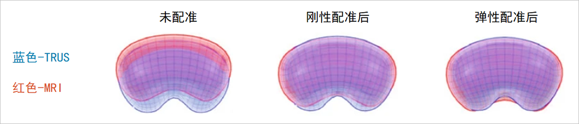 卡本医疗VENUS前列腺活检解决方案