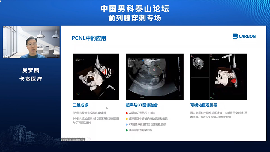 卡本VENUS多模态影像融合超声为泌尿外科患者提供更为精准的诊疗方案