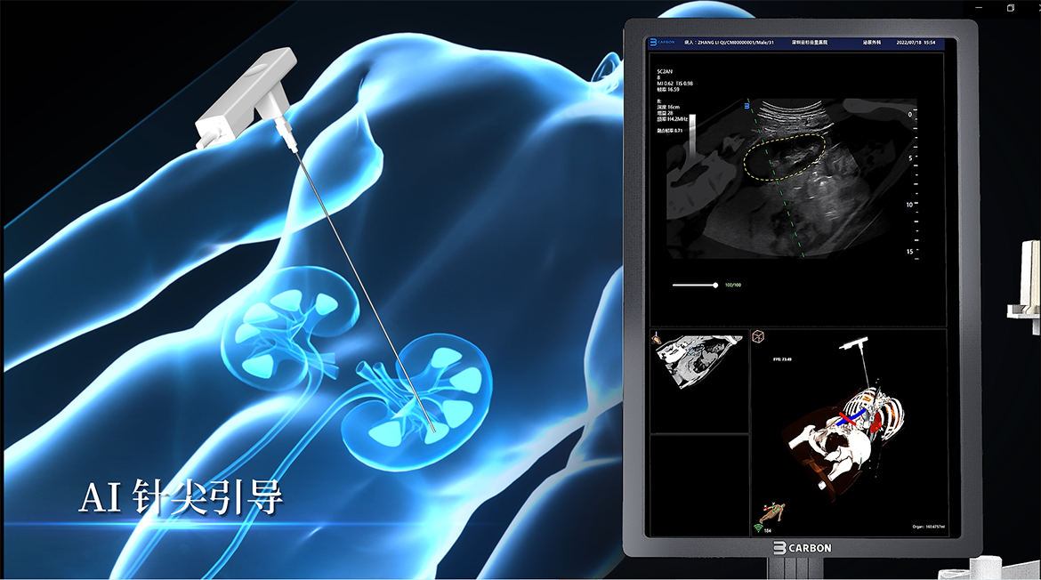 卡本VENUS入选《深圳市创新产品推广应用目录》助力推进我国精准医疗发展，有助于为患者提供更精准的诊疗方案，提升我国医疗器械和临床科学水平
